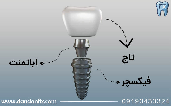 جنس ایمپلنت های مختلف