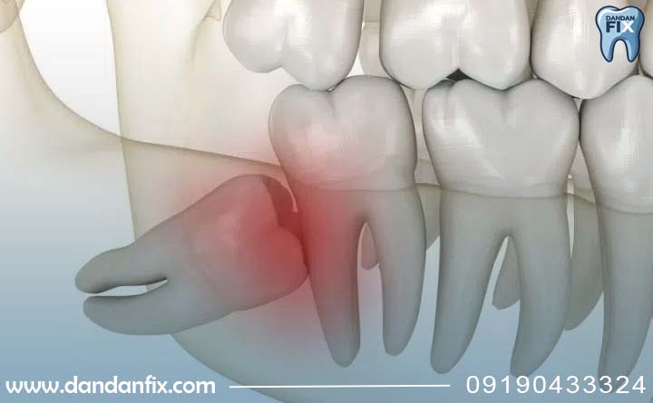 دندان عقل نهفته