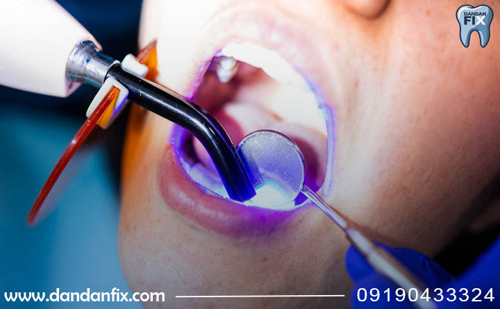 مزایا و معایب کامپوزیت دندان