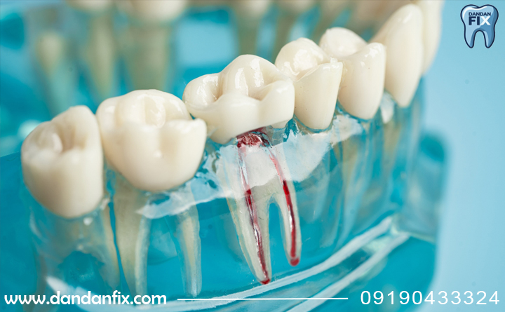 دلایل عصب کشی