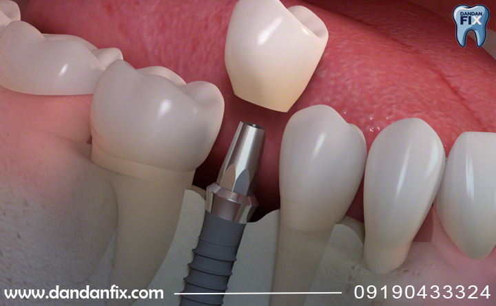 عمر ایمپلنت مگاژن