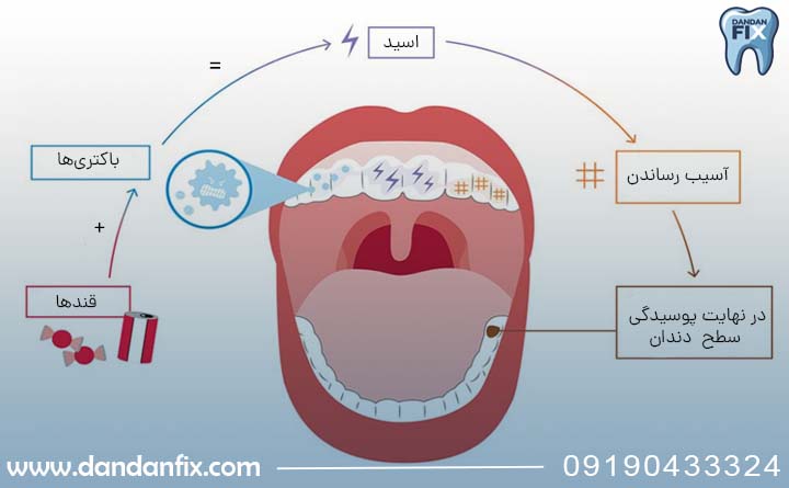 علت پوسیدن دندان