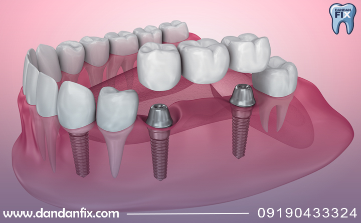 بریج دندان برپایه ایمپلنت
