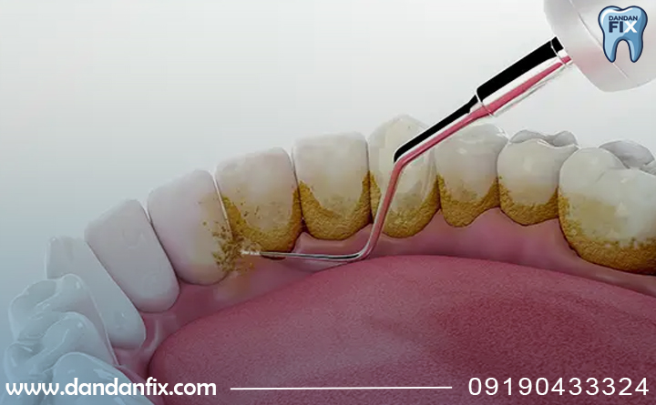 جرم گیری ایمپلنت دندان