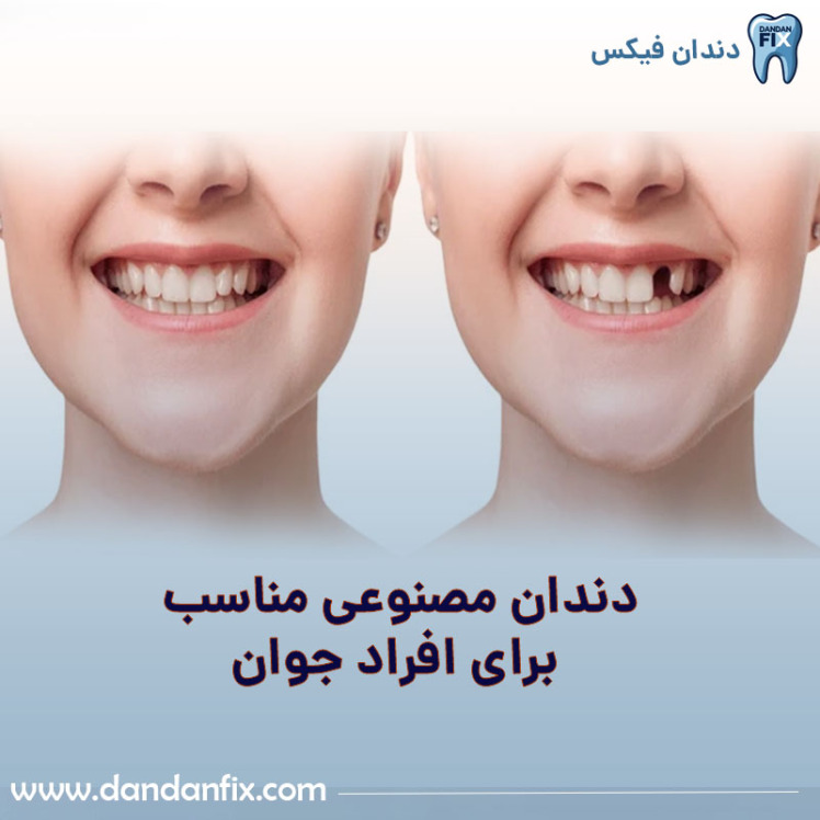 بهترین دندان مصنوعی برای افراد جوان + چه دندان مصنوعی برای جوانان مناسب است؟