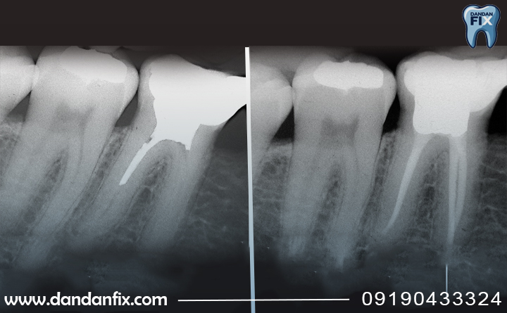 کی باید دندان را عصب کشی کنیم؟