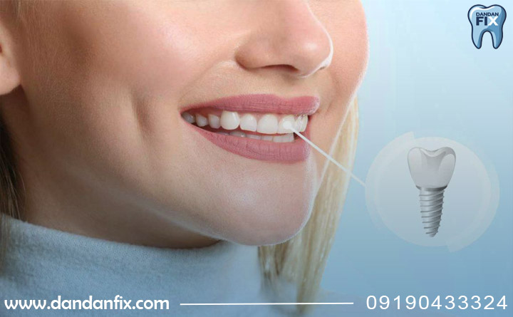 زیبایی ایمپلنت معمولی