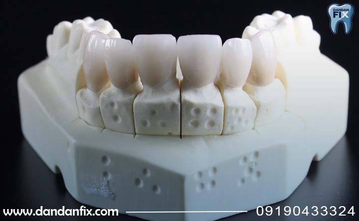 قالب گیری لمینت