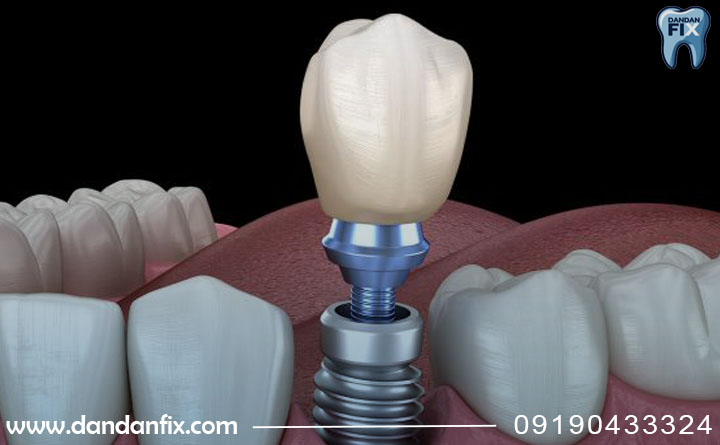 ایمپلنت دو مرحله ای