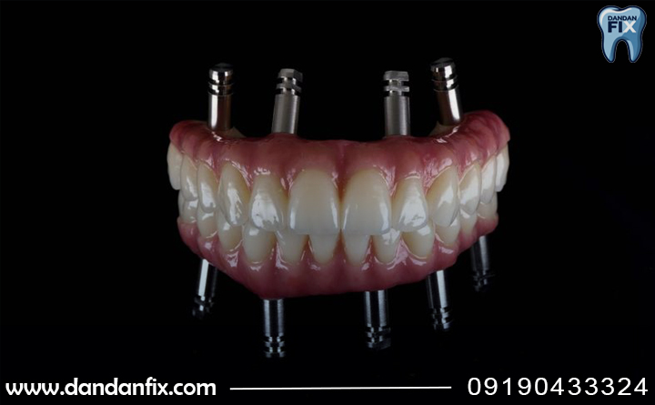 مزایای ایمپلنت All-on-6