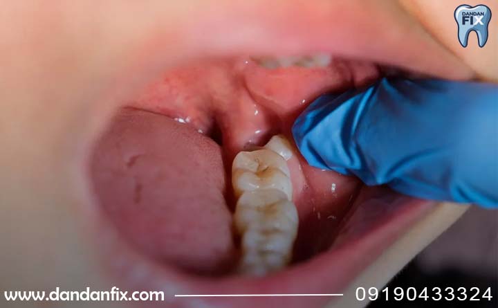 دندان عقل نهفته چه علائمی دارد؟