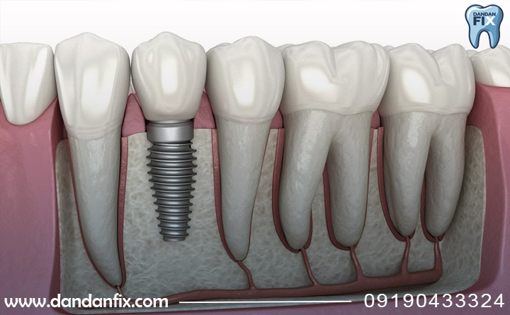 ایمپلنت دندان