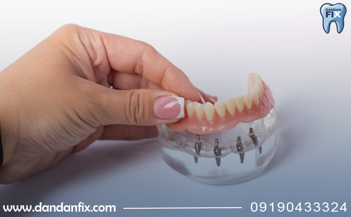 مزایا و معایب ایمپلنت اشترومن