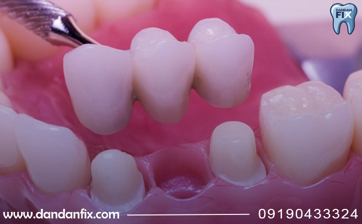 پروتز پارسیل چنده؟