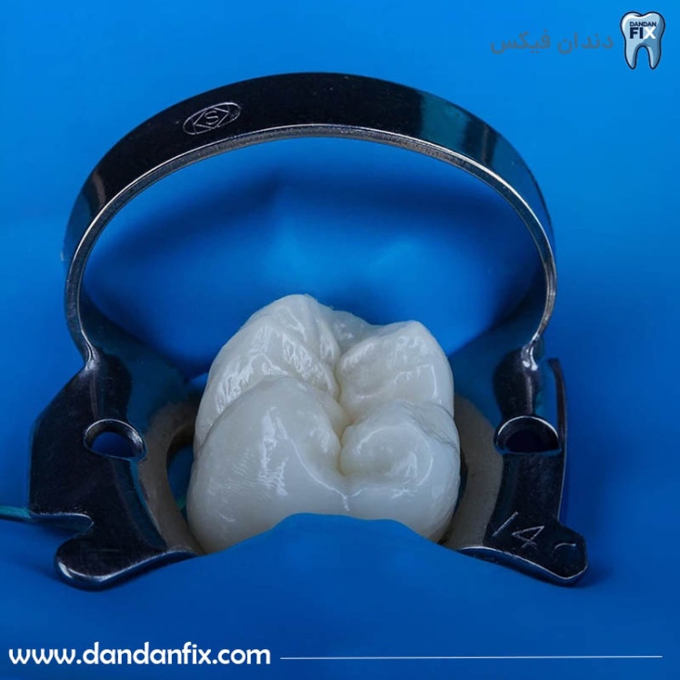 طول عمر کامپوزیت دندان + روش‌های افزایش ماندگاری کامپوزیت