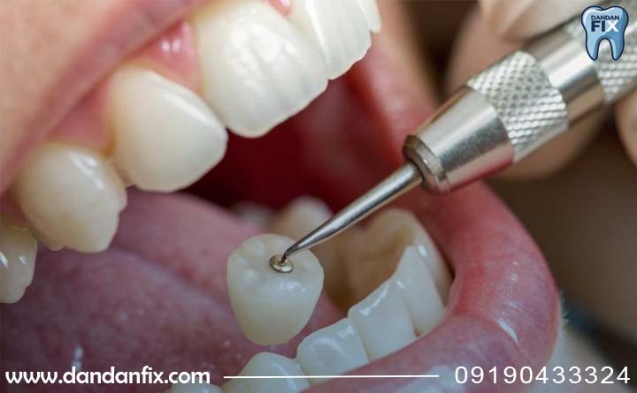 کدام روکش برای من مناسبتر است؟