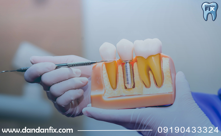 جراحی ایمپلنت