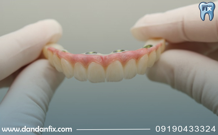 مراحل انجام All-on-4