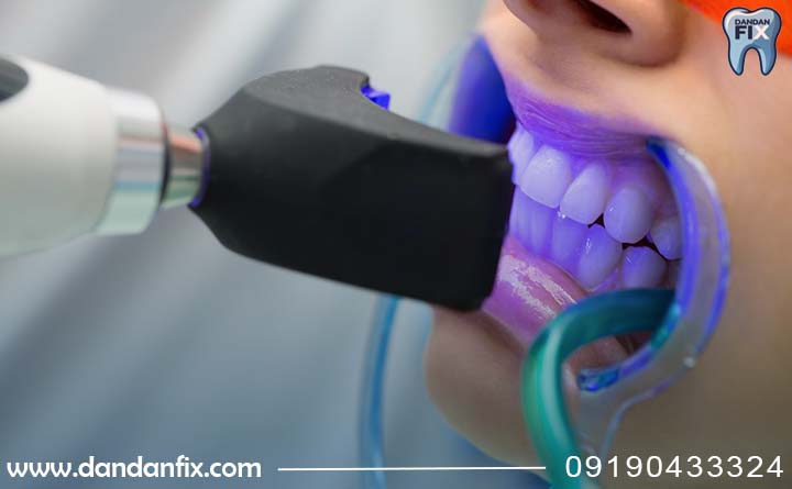 ایا بلیچینگ برای مینای دندان بده؟