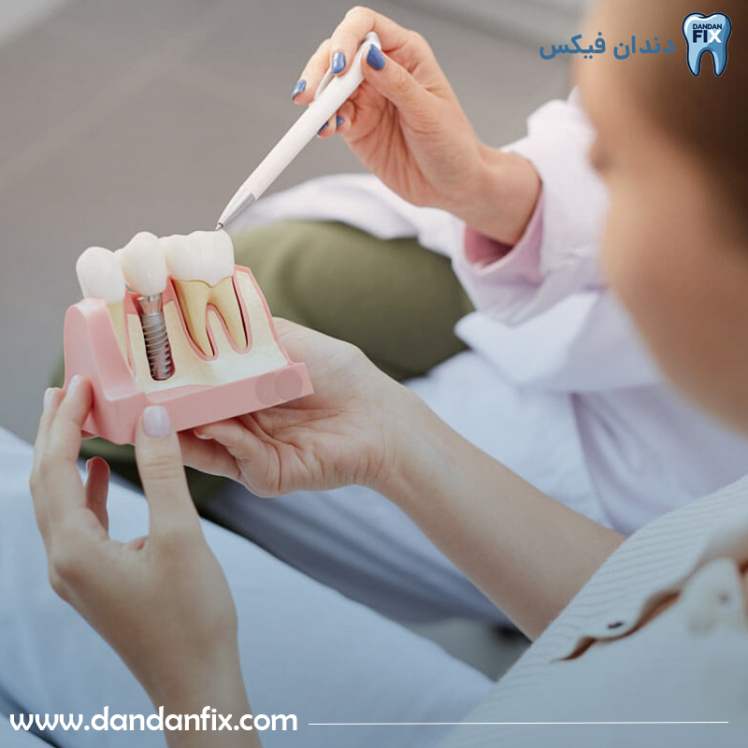 چه زمانی باید ایمپلنت دندان تعویض شود؟