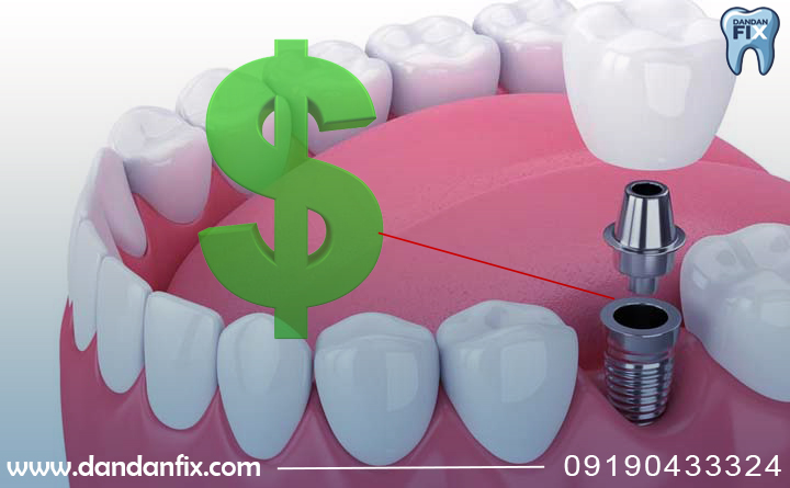 هزینه ایمپلنت