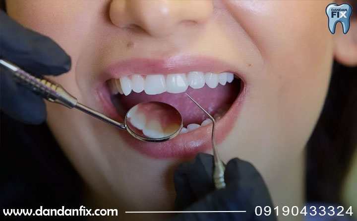 ترمیم یا تعویض کامپوزیت؟