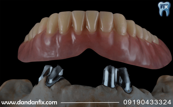 اوردنچر دندان