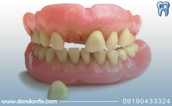 کامپوزیت روی دندان مصنوعی ممکن است؟