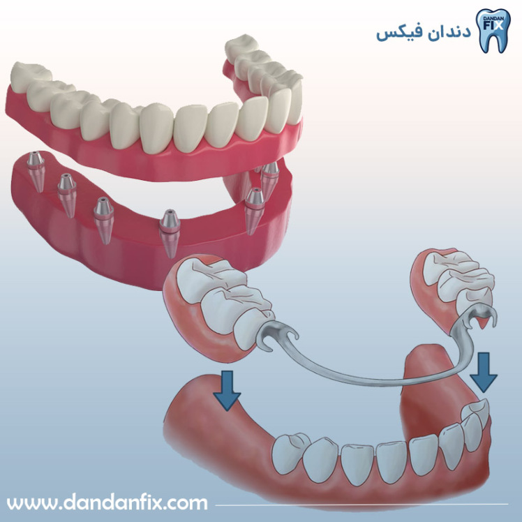 دست دندون ثابت بهتره یا متحرک؟ بررسی کامل با عکس و تجربه بیماران