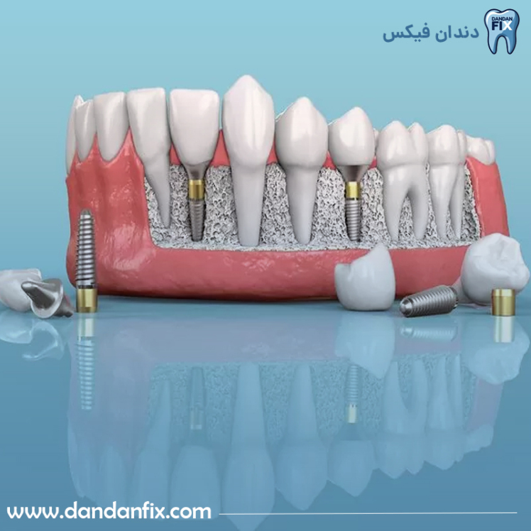 ایمپلنت دیجیتال چیست؟ ایمپلنت دیجیتال بهتره یا معمولی؟