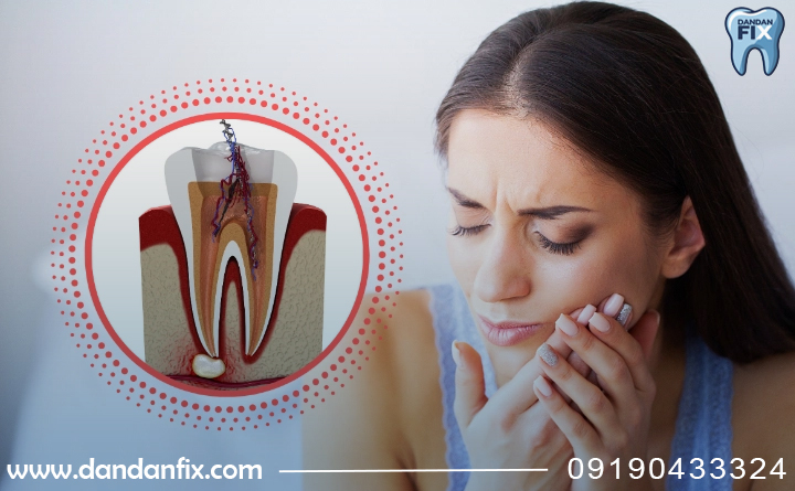 مراقبت‌های بعد از عصب کشی دندان