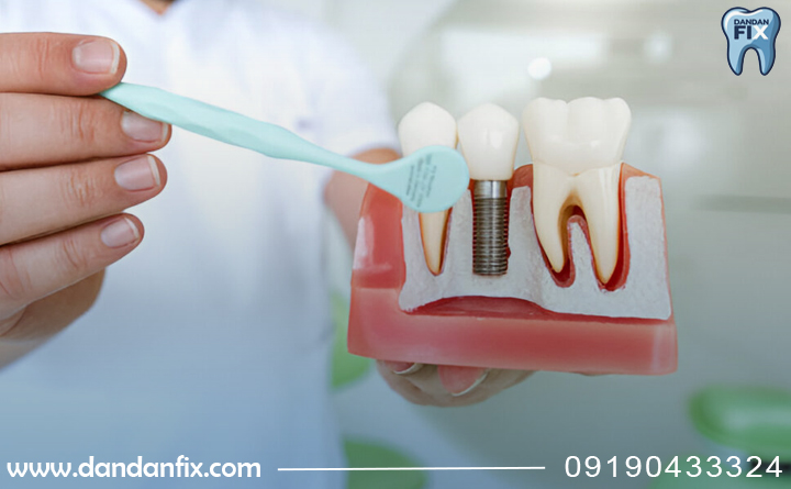 پیشگیری از لق شدن ایمپلنت