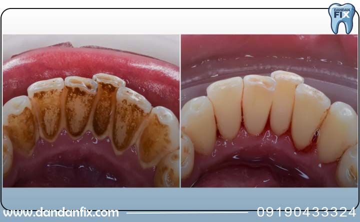 دلایل جرم گیری دندان