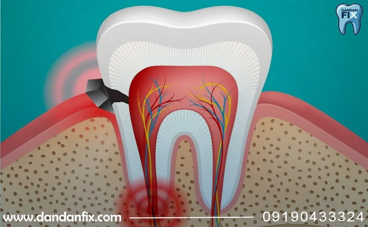 دندان درد در شب