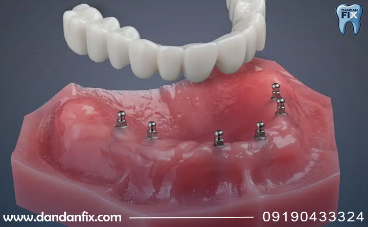 پروتز ثابت برای افراد جوان