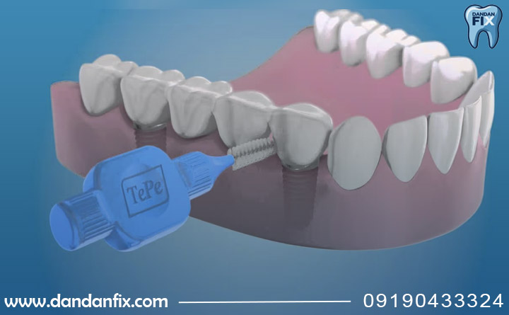 مسواک زدن ایمپلنت