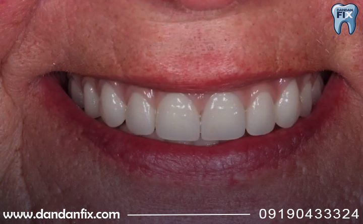 بهترین راه کاهش التهاب لثه بعد از دندان مصنوعی