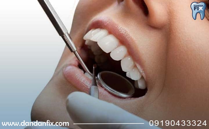 مراحل انجام لمینت