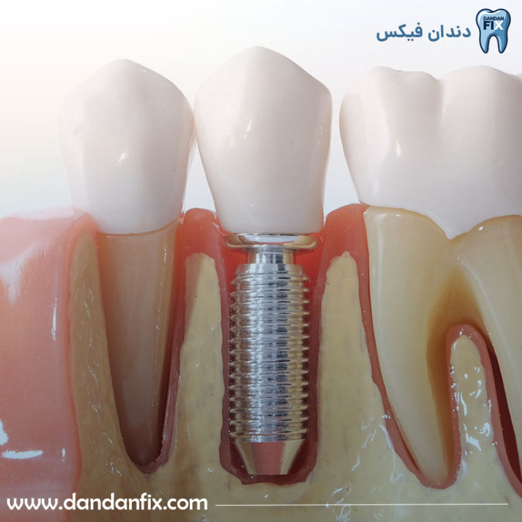 ایمپلنت دندان دو مرحله‌ای چیست؟ مراحل + مزایا و معایب
