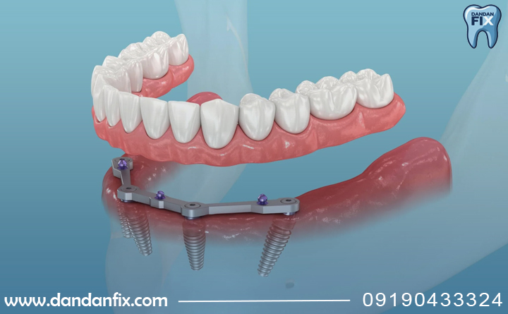ایمپلنت All-on-4