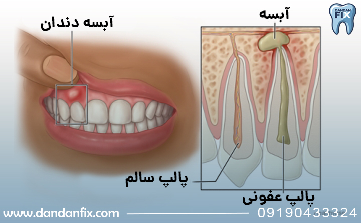 علت آبسه دندان
