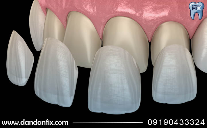 کاربردهای کامپوزیت دندان