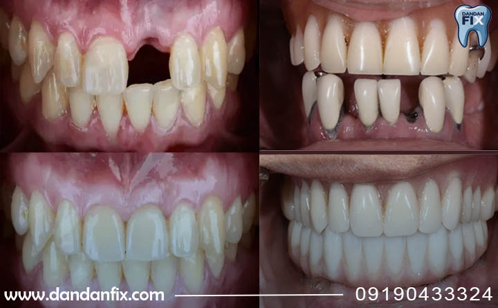 مزایای ایمپلنت