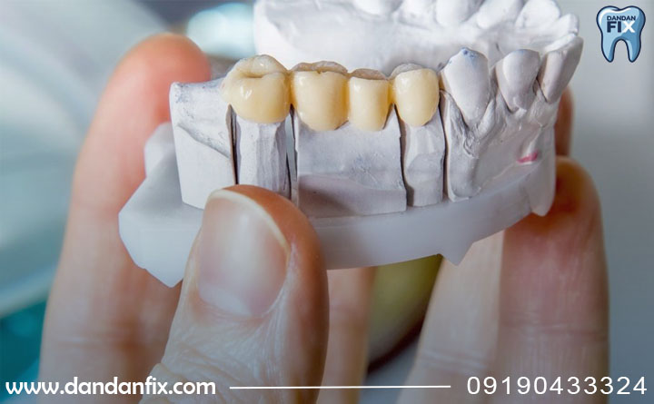 عمر و ماندگاری بریج