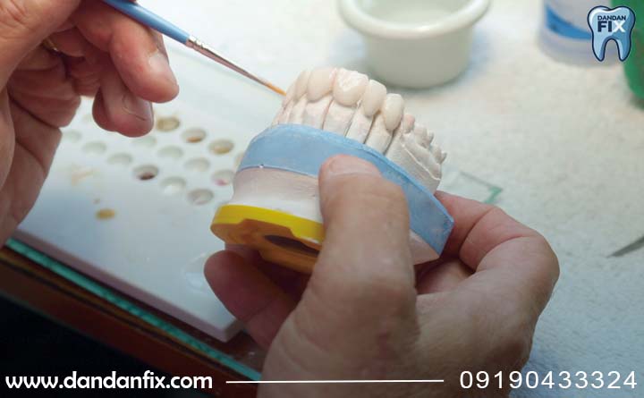 ساخت روکش در لابراتوار