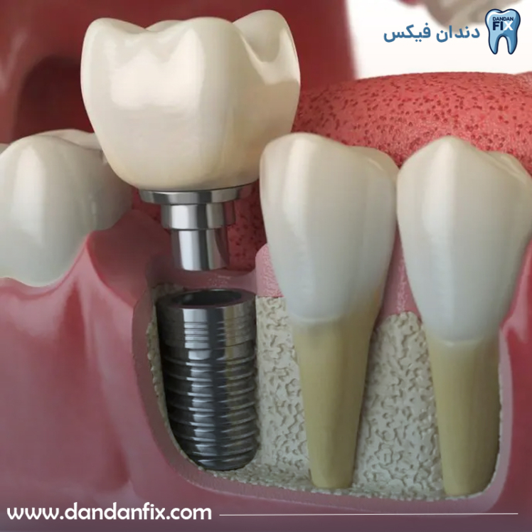 ایمپلنت دندان چقدر طول میکشد و چند جلسه است؟