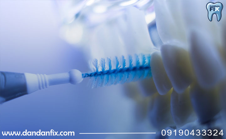 پیشگیری از عوارض ایمپلنت