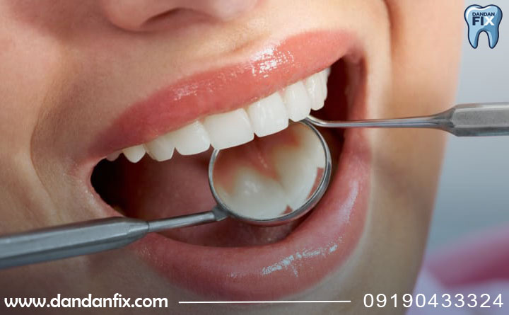 علل افتادن کامپوزیت