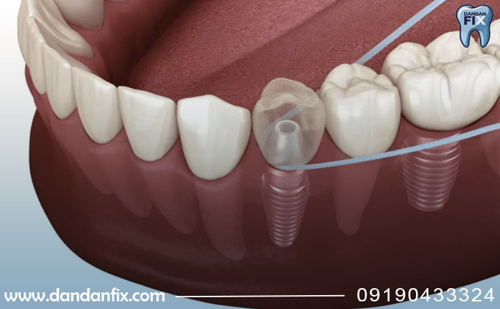 مراقبت های پس از ایمپلنت دندان