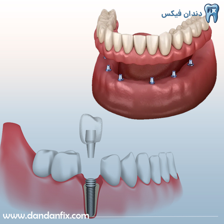فرق ایمپلنت با دندان مصنوعی ثابت چیست؟ مقایسه ایمپلنت و پروتز ثابت
